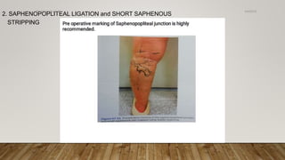 2. SAPHENOPOPLITEAL LIGATION and SHORT SAPHENOUS
STRIPPING
4/4/2019Shubham Gupta ©
 