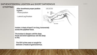 SAPHENOFEMORAL LIGATION and SHORT SAPHENOUS
STRIPPING
4/4/2019Shubham Gupta ©
 
