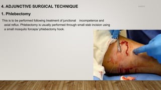 4. ADJUNCTIVE SURGICAL TECHNIQUE
1. Phlebectomy
This is to be performed following treatment of junctional incompetence and
axial reflux. Phlebectomy is usually performed through small stab incision using
a small mosquito forceps/ phlebectomy hook.
4/4/2019Shubham Gupta ©
 
