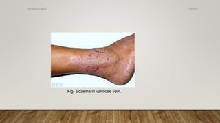 Fig- Eczema in varicose vein.
4/4/2019Shubham Gupta ©
 