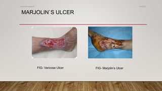 MARJOLIN`S ULCER
FIG- Varicose Ulcer FIG- Marjolin’s Ulcer
4/4/2019Shubham Gupta ©
 
