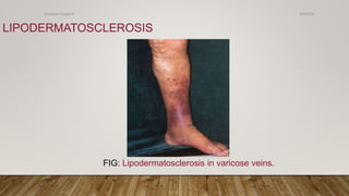 LIPODERMATOSCLEROSIS
FIG: Lipodermatosclerosis in varicose veins.
4/4/2019Shubham Gupta ©
 