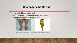 Champagne bottle sign
• Inverted beer bottle look
• Contraction of ankle skin and s/c tissue
with prominent edematous calf
FIG:- Champagne bottle sign in deep vein thrombosis and lipodermatosis.
4/4/2019Shubham Gupta ©
 