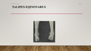 TALIPES EQINOVARUS
4/4/2019Shubham Gupta ©
 