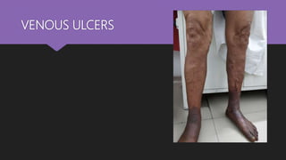 VENOUS ULCERS
 