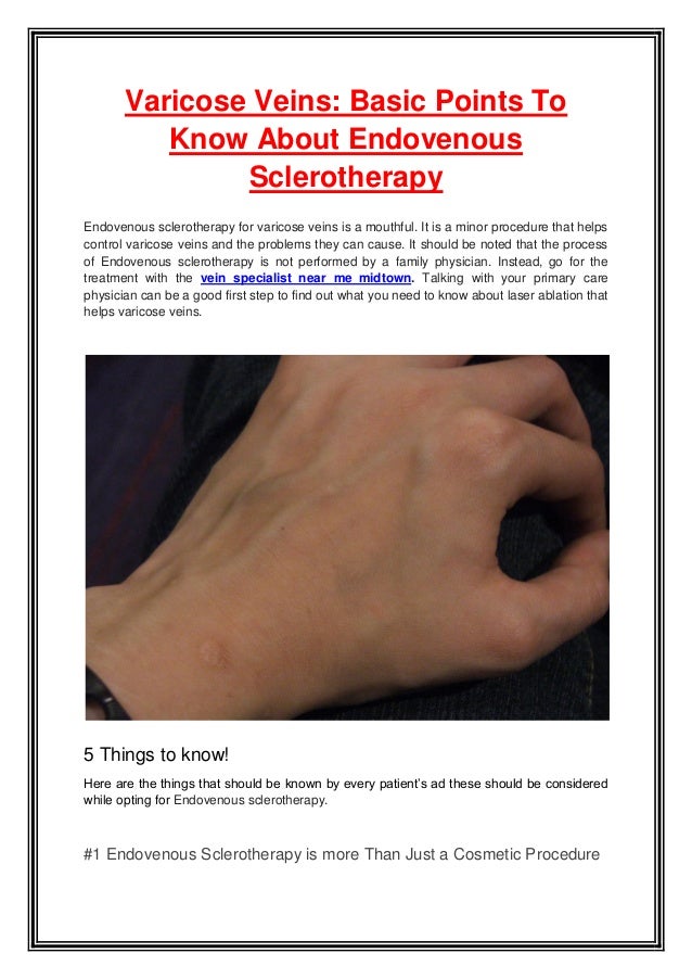 Varicose veins basic points to know about endovenous sclerotherapy