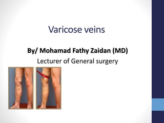 Varicose veins
By/ Mohamad Fathy Zaidan (MD)
Lecturer of General surgery
 