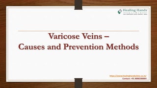 Varicose Veins –
Causes and Prevention Methods
https://www.healinghandsclinic.co.in/
Contact: +91 8888288884
 