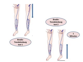 Varicose vein, Venous ulcer.pptx