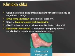 Varikozne vene | PPSX