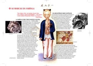 AS MARCAS DA VARÍOLA
OS REGISTROS MAIS ANTIGOS
da varíola foram encontrados em egípcios mumificados há
cerca de 3 mil anos. Do Vale do Nilo, espalhou-se para a
Índia, chegando à China no século I d.C. As primeiras
descrições da doença são do médico chinês Ko
Hung (340 d.C), de Ahrun de Alexandria (622)
e do persa Abui-Bekr Al-Razi (Rhazes),
em seu livro De Pestilentia, no século X.
É possível que a moléstia tenha sido
a causa de epidemias como a Praga de
Atenas (430 a.C.), a Praga Antonina (165)
e pela devastação do exército etíope na
Guerra dos Elefantes em Meca (568).
A primeira referência à doença na Europa foi feita por
Gregório de Tours, cronista do reino franco, em 582, relatando
a morte de dois jovens príncipes por uma moléstia que
chamou de corales. Ela retornou às terras européias no século
VIII, junto com os sarracenos, e espalhou-se pelo continente,
levada pelos cruzados, provocando epidemias devastadoras.
Epidemias de varíola na Inglaterra no século XVII
apresentavam taxas de mortalidade equivalentes a
um sexto da natalidade. Calcula-se que somente no século
XVIII, quando era endêmica na maior parte do mundo,
a doença matou mais de 60 milhões de pessoas.
A VARÍOLA ERA UMA DOENÇA AGUDA,
causada por um vírus – o Poxvirus variolae.
Ocorria sob duas formas, com comportamentos
epidemiológicos distintos, mas manifestações
clínicas semelhantes. A varíola major,
popularmente conhecida como bexiga,
caracterizava-se por quadros clínicos mais
graves e alto índice de mortalidade. A varíola
minor, ou alastrim, mais branda, matava
menos de 1% dos atingidos.
O período de incubação durava de
10 a 14 dias. As primeiras manifestações
da doença eram febre, mal-estar e dores de cabeça e
nas costas. Dois a três dias depois, começavam
repentinamente as erupções na pele, normalmente
no rosto, nos braços e nas pernas. A princípio, eram
pequenas brotoejas, que evoluíam depois para pústulas
(bolhas purulentas). Muitas vezes, estas lesões eram
confluentes, isto é, carreiras de pústulas se unindo
ao longo do corpo, formando o que popularmente se
chamava de bexiga de canudo. Nas formas mais graves,
os pacientes apresentavam hemorragias na pele e nas
mucosas, falecendo entre o quinto e o sexto dia.
Com freqüência, a varíola deixava cicatrizes na
pele, especialmente na face. Outras seqüelas mais raras
eram cegueira e deformidades nos membros.
Entre os ortopoxvirus, figuram ainda os vírus
da varíola do camundongo, de camelos, de macacos,
de bovinos (cowpox) e da vacínia (um mutante
utilizado na vacina). Os três últimos podem
infectar o homem.
“Para mitigar a febre, você asperge, do pote cheio,
com a vassoura, a água da imortalidade.(...) Você refresca
o calor escaldante das pústulas; Shitala, eu te venero.”
Oração indiana
Vírus da varíola em membrana
visto ao microscópio.
Mumificado em 1157 a.C.,
o faraó Ramsés V mostra,
em seu rosto, cicatrizes
características da varíola.
Gravura medieval de
Guerreiro Sarraceno.
Ao lado, menina com varíola, s/d.
Acervo Biblioteca Nacional de Paris.
 