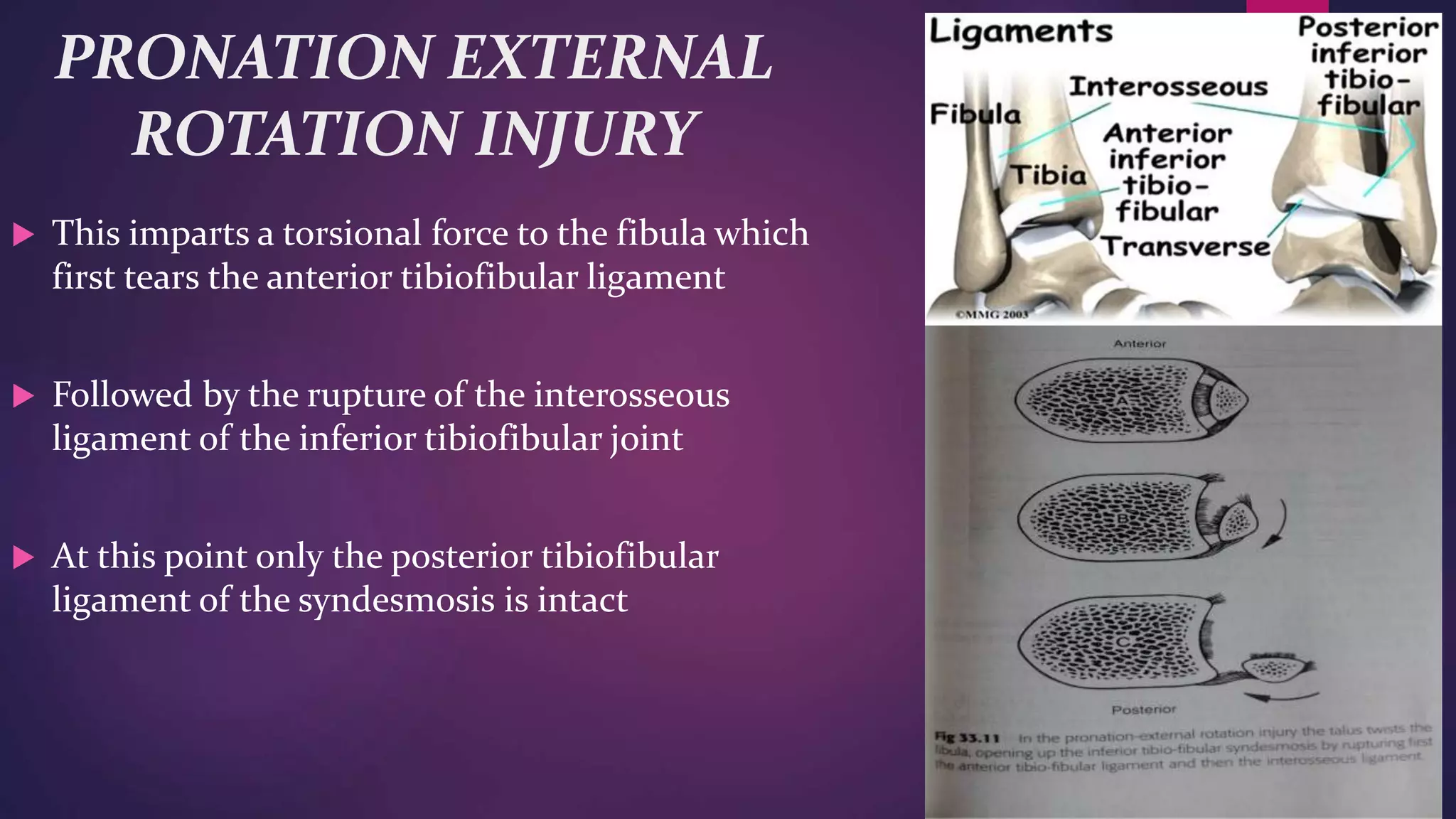 Various ankle injuries and it’s management | PPTX