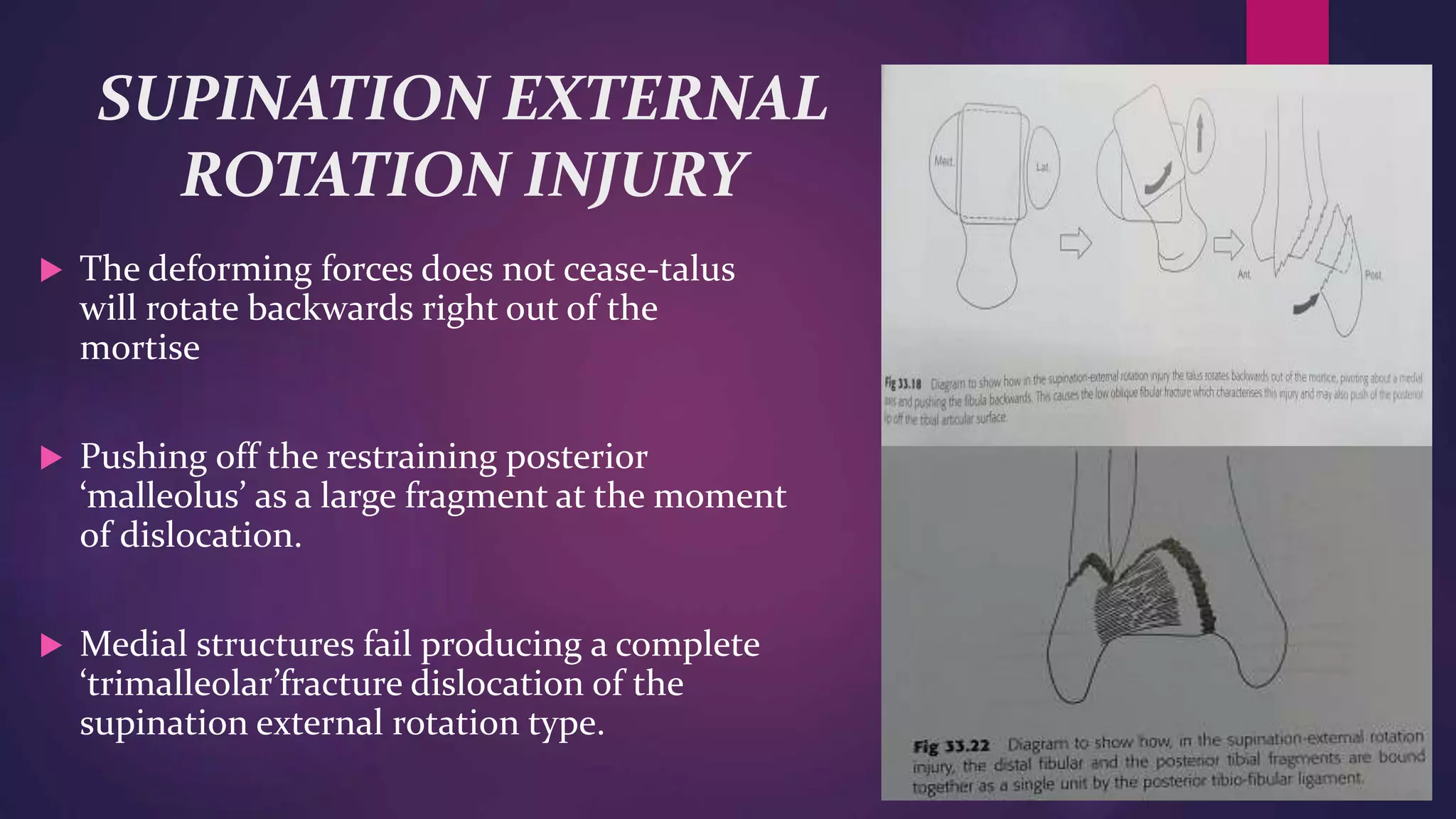 Various ankle injuries and it’s management | PPTX