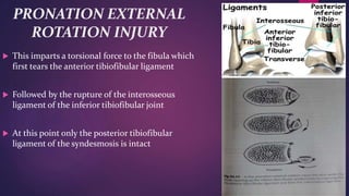PRONATION EXTERNAL
ROTATION INJURY
 This imparts a torsional force to the fibula which
first tears the anterior tibiofibular ligament
 Followed by the rupture of the interosseous
ligament of the inferior tibiofibular joint
 At this point only the posterior tibiofibular
ligament of the syndesmosis is intact
 
