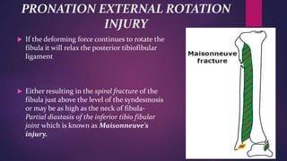 PRONATION EXTERNAL ROTATION
INJURY
 If the deforming force continues to rotate the
fibula it will relax the posterior tibiofibular
ligament
 Either resulting in the spiral fracture of the
fibula just above the level of the syndesmosis
or may be as high as the neck of fibula-
Partial diastasis of the inferior tibio fibular
joint which is known as Maisonneuve’s
injury.
 