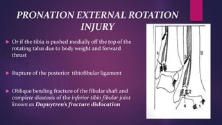 PRONATION EXTERNAL ROTATION
INJURY
 Or if the tibia is pushed medially off the top of the
rotating talus due to body weight and forward
thrust
 Rupture of the posterior tibiofibular ligament
 Oblique bending fracture of the fibular shaft and
complete diastasis of the inferior tibio fibular joint
known as Dupuytren’s fracture dislocation
 