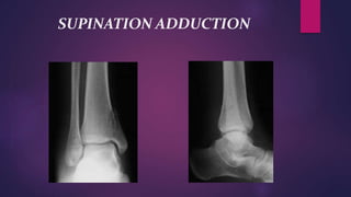 SUPINATION ADDUCTION
 