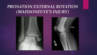PRONATION EXTERNAL ROTATION
(MAISSONEUVE’S INJURY)
 