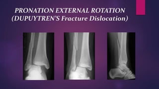 PRONATION EXTERNAL ROTATION
(DUPUYTREN’S Fracture Dislocation)
 