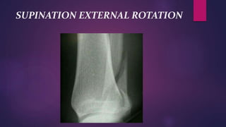 SUPINATION EXTERNAL ROTATION
 