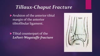 Tillaux-Chaput Fracture
 Avulsion of the anterior tibial
margin of the anterior
tibiofibular ligament.
 Tibial counterpart of the
LeFort-Wagstaffe fracture
 