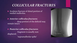 COLLICULAR FRACTURES
 Avulsion fracture of distal portion of
medial malleolus.
 Anterior colliculus fractures
deep portion of the deltoid may
remain intact.
 Posterior colliculus fractures
fragment is usually non
displaced.
‘supramalleolar spike’
 