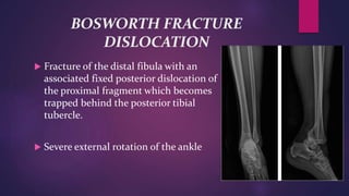 BOSWORTH FRACTURE
DISLOCATION
 Fracture of the distal fibula with an
associated fixed posterior dislocation of
the proximal fragment which becomes
trapped behind the posterior tibial
tubercle.
 Severe external rotation of the ankle
 