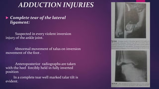 ADDUCTION INJURIES
 Complete tear of the lateral
ligament:
Suspected in every violent inversion
injury of the ankle joint.
Abnormal movement of talus on inversion
movement of the foot .
Anteroposterior radiographs are taken
with the heel forcibly held in fully inverted
position
In a complete tear well marked talar tilt is
evident.
 