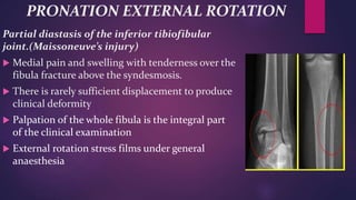 PRONATION EXTERNAL ROTATION
Partial diastasis of the inferior tibiofibular
joint.(Maissoneuve’s injury)
 Medial pain and swelling with tenderness over the
fibula fracture above the syndesmosis.
 There is rarely sufficient displacement to produce
clinical deformity
 Palpation of the whole fibula is the integral part
of the clinical examination
 External rotation stress films under general
anaesthesia
 