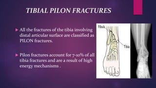 TIBIAL PILON FRACTURES
 All the fractures of the tibia involving
distal articular surface are classified as
PILON fractures.
 Pilon fractures account for 7-10% of all
tibia fractures and are a result of high
energy mechanisms .
 