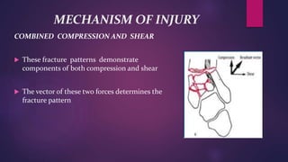 MECHANISM OF INJURY
COMBINED COMPRESSION AND SHEAR
 These fracture patterns demonstrate
components of both compression and shear
 The vector of these two forces determines the
fracture pattern
 