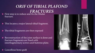 ORIF OF TIBIAL PLAFOND
FRACTURES
 First step is to reduce and fix the fibular
fracture.
 This locates a major lateral tibial fragment.
 The tibial fragments are then exposed
 Reconstruction of the joint surface is done and
fracture fragments are fixed with
interfragmentary screws and buttress plate.
 Cancellous bone graft
 