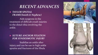 RECENT ADVANCES
 TAYLOR SPATIAL
FRAME(Smith & Nephew)
Aids surgeons in the
treatment of difficult crush injuries
to the distal tibia involving the
ankle.
 SUTURE ANCHOR FIXATION
FOR SYNDESMOTIC INJURY
Stabilise an ankle after
injury and can be use in high ankle
sprains and fractures of the fibula
 