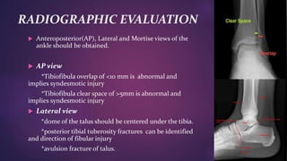 RADIOGRAPHIC EVALUATION
 Anteroposterior(AP), Lateral and Mortise views of the
ankle should be obtained.
 AP view
*Tibiofibula overlap of <10 mm is abnormal and
implies syndesmotic injury
*Tibiofibula clear space of >5mm is abnormal and
implies syndesmotic injury
 Lateral view
*dome of the talus should be centered under the tibia.
*posterior tibial tuberosity fractures can be identified
and direction of fibular injury
*avulsion fracture of talus.
 