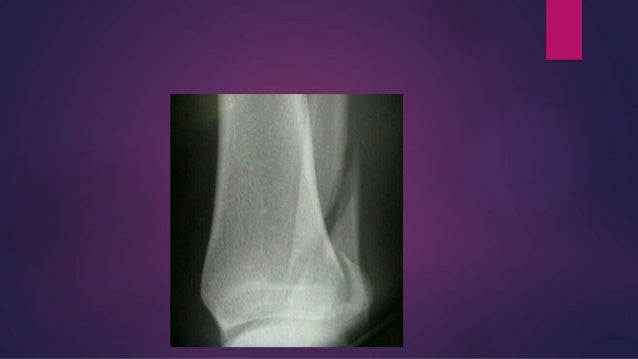 Various ankle injuries and it's management