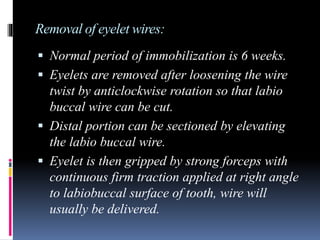 Various intermaxillary fixation techniques | PPTX