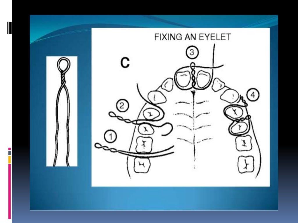 Various intermaxillary fixation techniques