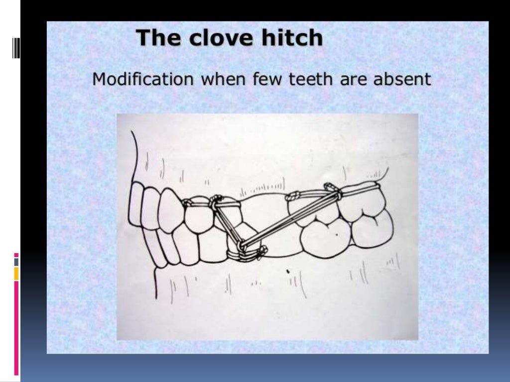 Various intermaxillary fixation techniques