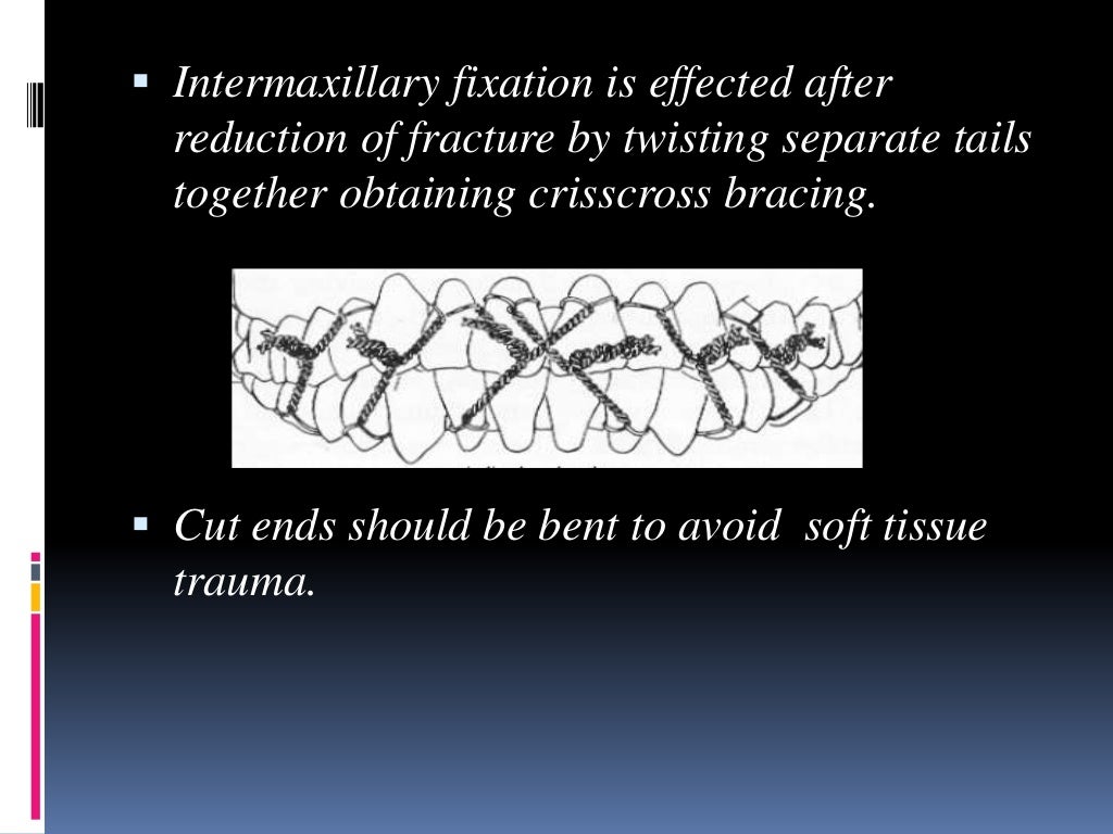 Various intermaxillary fixation techniques