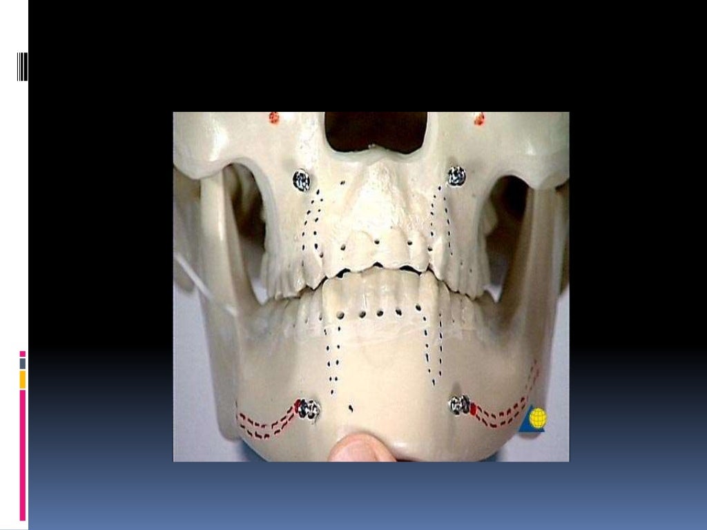 Various intermaxillary fixation techniques