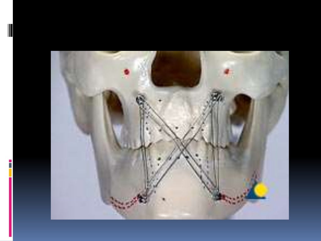 Various intermaxillary fixation techniques