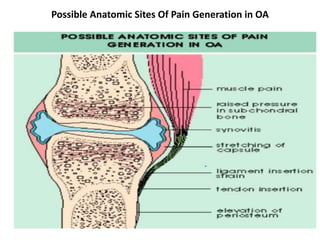 Possible Anatomic Sites Of Pain Generation in OA
 