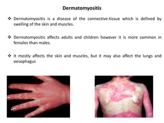 Dermatomyositis
 Dermatomyositis is a disease of the connective-tissue which is defined by
swelling of the skin and muscles.
 Dermatomyositis affects adults and children however it is more common in
females than males.
 It mostly affects the skin and muscles, but it may also affect the lungs and
oesophagus
 