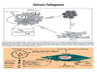 Sclerosis: Pathogenesis
 