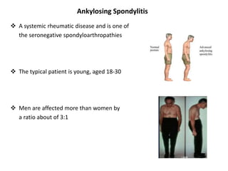 Ankylosing Spondylitis
 A systemic rheumatic disease and is one of
the seronegative spondyloarthropathies
 The typical patient is young, aged 18-30
 Men are affected more than women by
a ratio about of 3:1
 