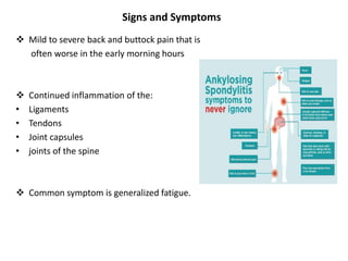 Signs and Symptoms
 Mild to severe back and buttock pain that is
often worse in the early morning hours
 Continued inflammation of the:
• Ligaments
• Tendons
• Joint capsules
• joints of the spine
 Common symptom is generalized fatigue.
 