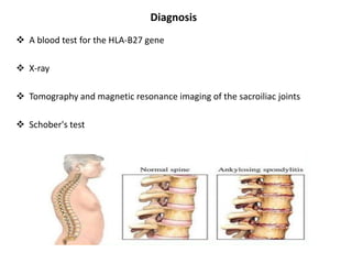 Diagnosis
 A blood test for the HLA-B27 gene
 X-ray
 Tomography and magnetic resonance imaging of the sacroiliac joints
 Schober's test
 