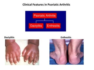 Clinical Features in Psoriatic Arthritis
Dactylitis Enthesitis
 