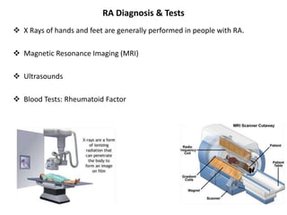 RA Diagnosis & Tests
 X Rays of hands and feet are generally performed in people with RA.
 Magnetic Resonance Imaging (MRI)
 Ultrasounds
 Blood Tests: Rheumatoid Factor
 
