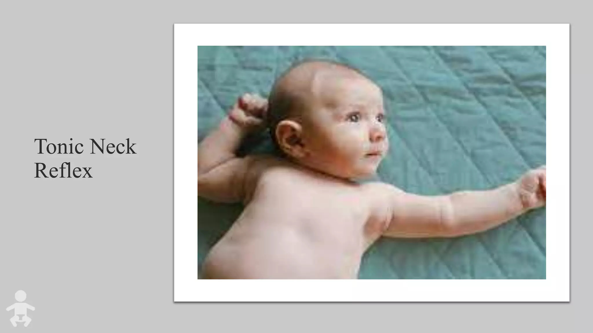 Tonic Neck
Reflex
 